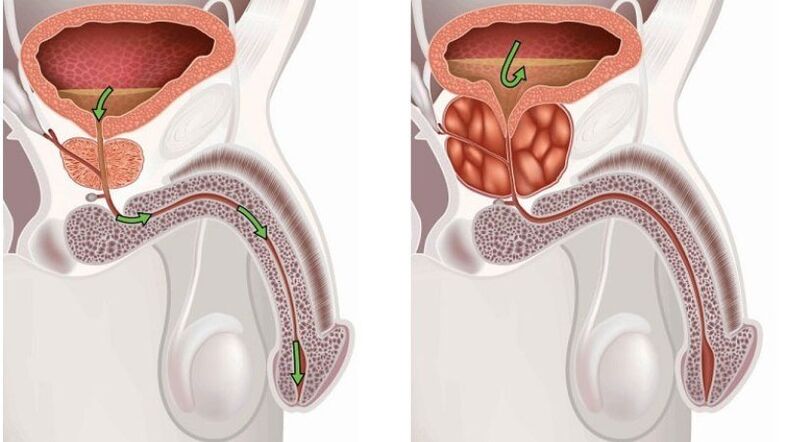 Prostate saine et enflammée avec prostatite.