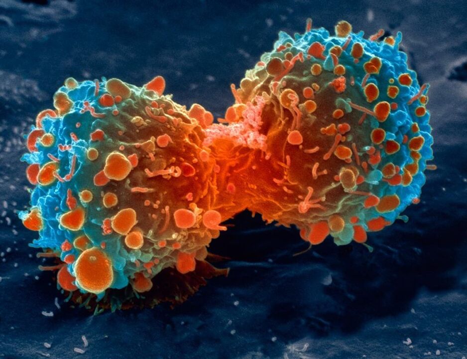 Cellule tumorale comme complication de la prostatite.