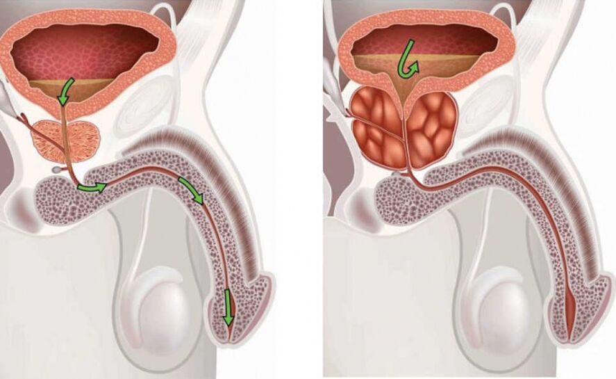 prostate saine et malade chez les hommes